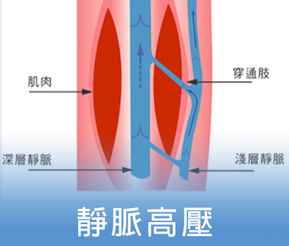 靜脈曲張成因－靜脈高壓