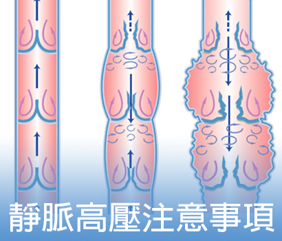 靜脈高壓注意事項