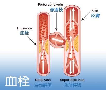 血栓