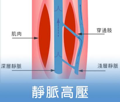 靜脈曲張成因－靜脈高壓