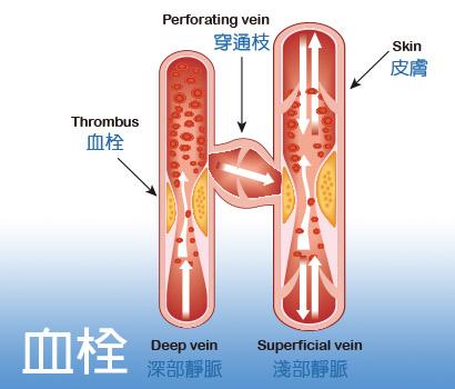 血栓