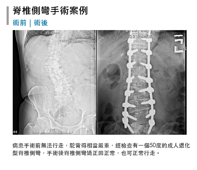 手術後脊椎側玩矯正回正常