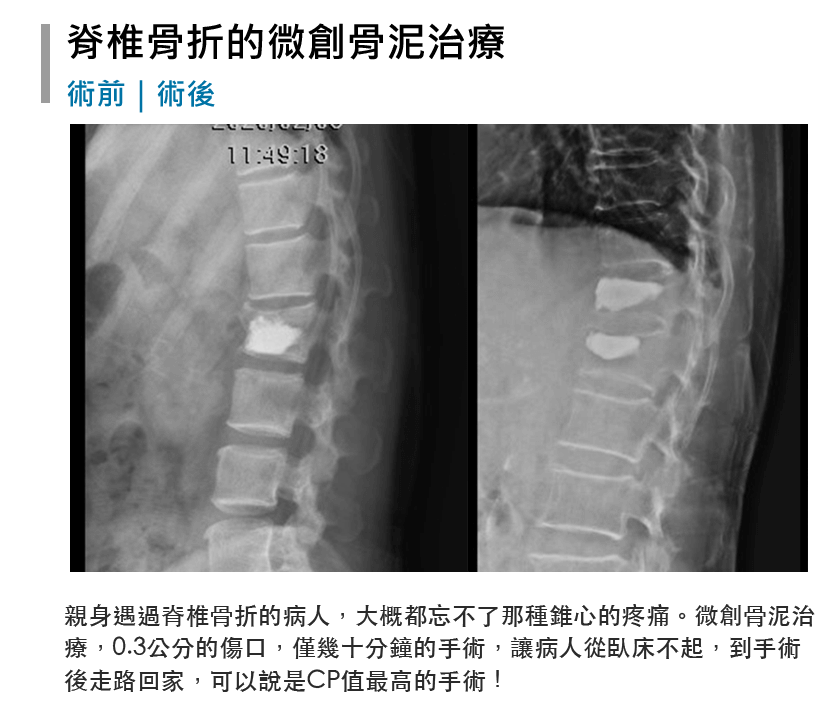 張軒侃醫師 脊椎側彎微創手術