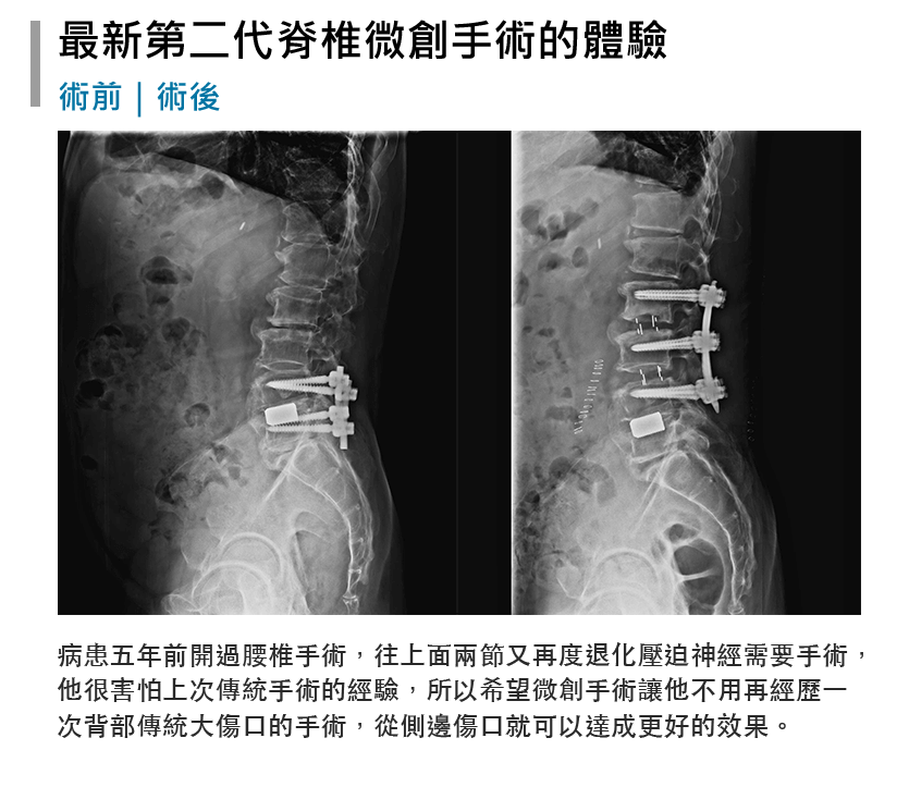 張軒侃醫師 脊椎側彎微創手術