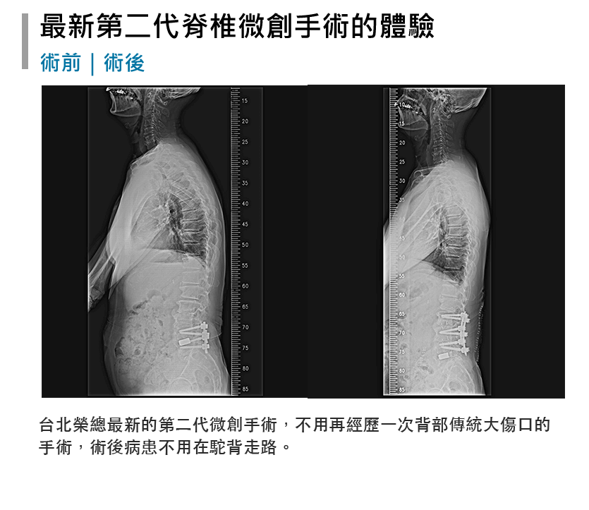 台北榮總最新第二代為創手術