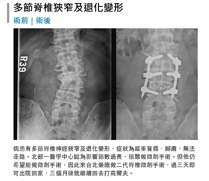 張軒侃醫師 脊椎側彎微創手術