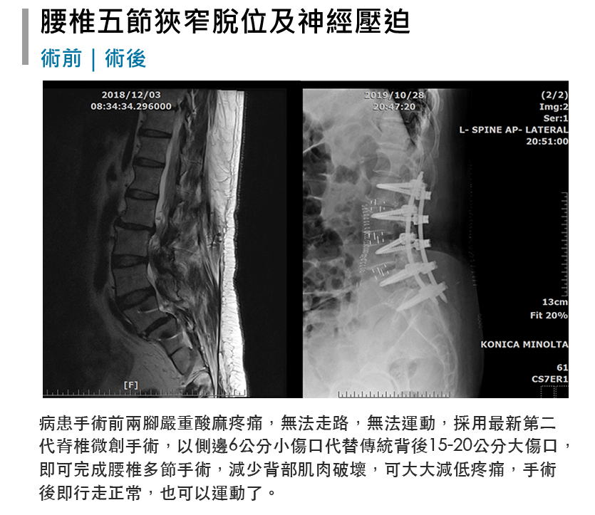 張軒侃醫師 脊椎側彎微創手術