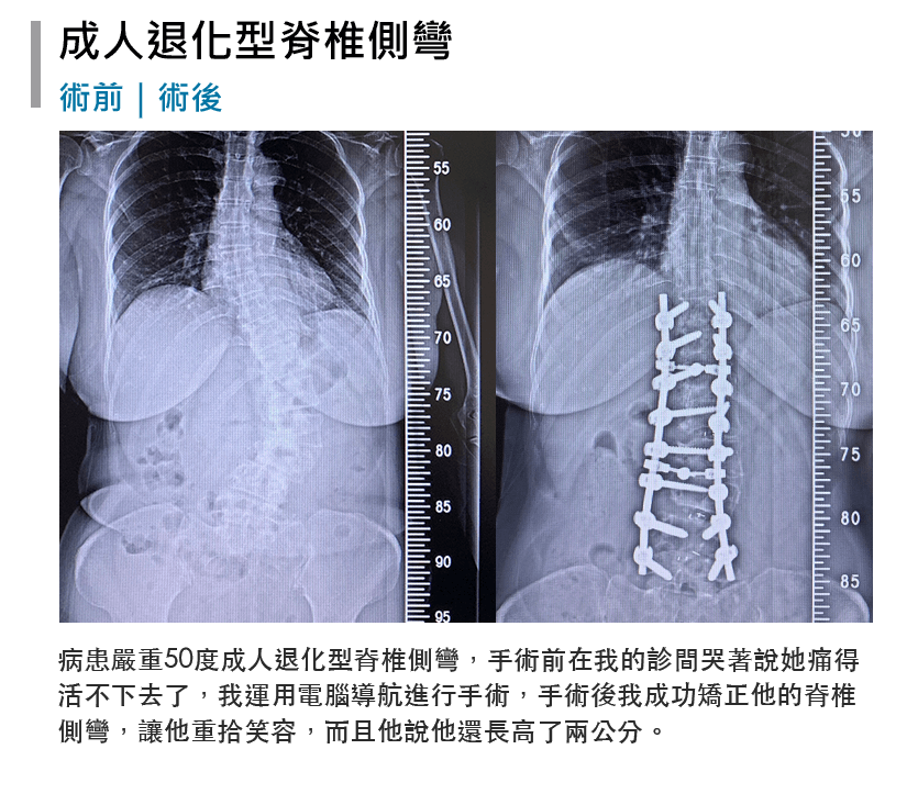 張軒侃醫師 脊椎側彎微創手術